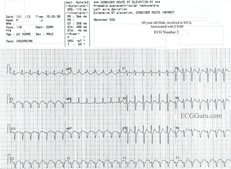 Hemiblock | ECG Guru - Instructor Resources