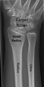 Image result for Simple Radius Fracture