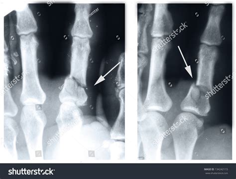 Index Finger Fracture X Ray at Catherine Grant blog