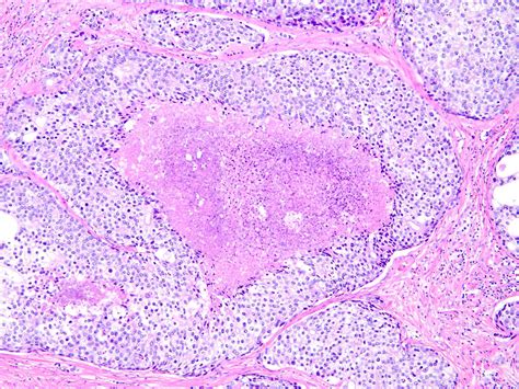 What Is Intraductal Prostate Cancer - Damian Moore Kapsels