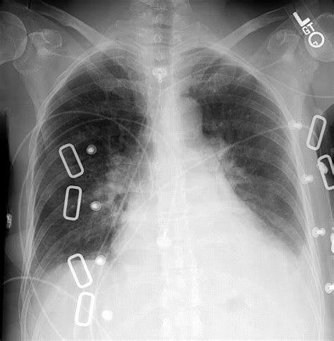 Cephalization Of Pulmonary Vessels