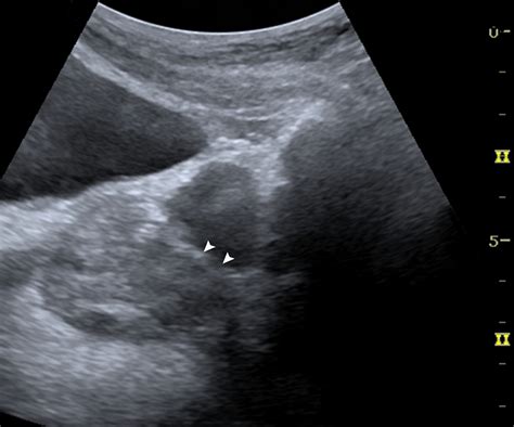Space Of Retzius Ultrasound