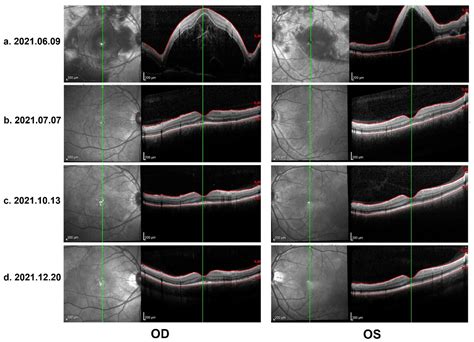 Probable Vogt–Koyanagi–Harada Disease after COVID-19 Vaccination: Case ...
