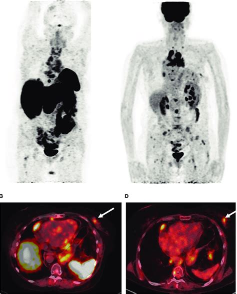 Image result for DOTA-TATE Scan