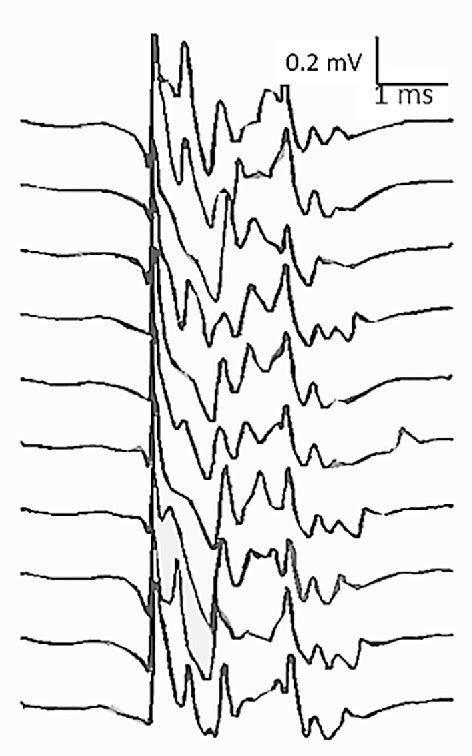 Image result for Single Fiber EMG Test
