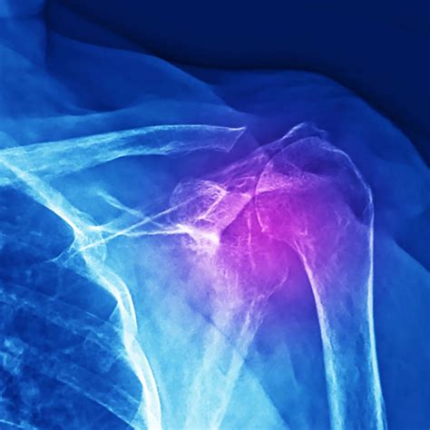 Arthroscopic Shoulder Surgery