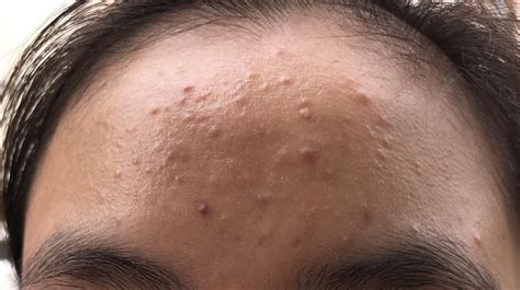 24/F. Was experiencing the worst episode of acne in my life. Had these tiny bumps on my forehead ...
