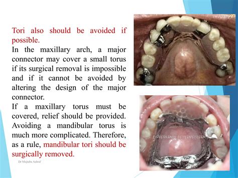 Major connector In prosthodontics | PPTX