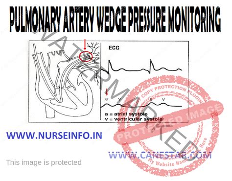 Pulmonary Cap Wedge Pressure