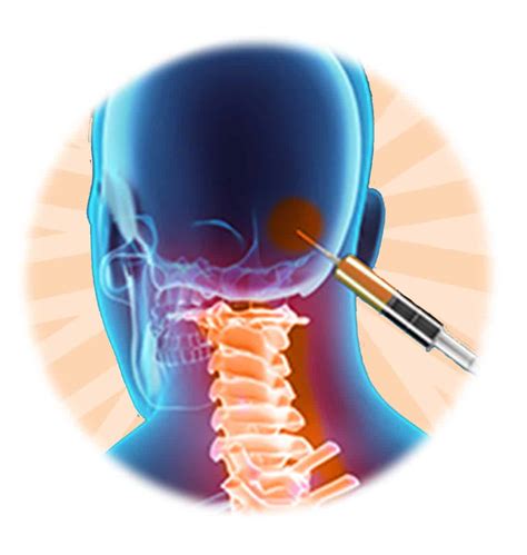 Occipital Nerve Block Occipital Nerve Block | Pain Relief In The