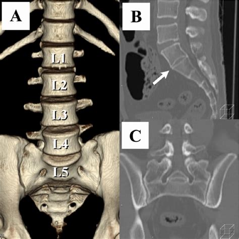 Figure 1 from The association between lumbar rib and lumbosacral transitional vertebrae ...