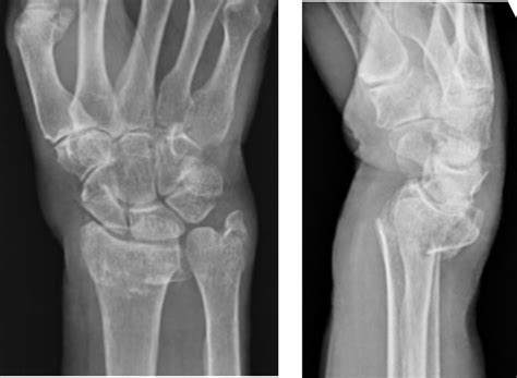 Image result for Simple Radius Fracture