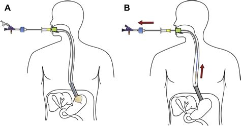 Esophageal Endoscopic Procedure at Bulah Judah blog