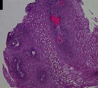 esophageal polyp 的图像结果