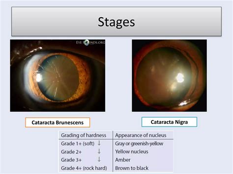 Types Of Cataract | PPTX