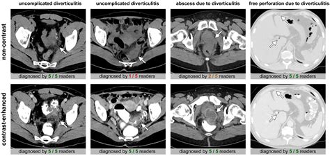 Comparison of Non-Contrast CT vs. Contrast-Enhanced CT with Both ...