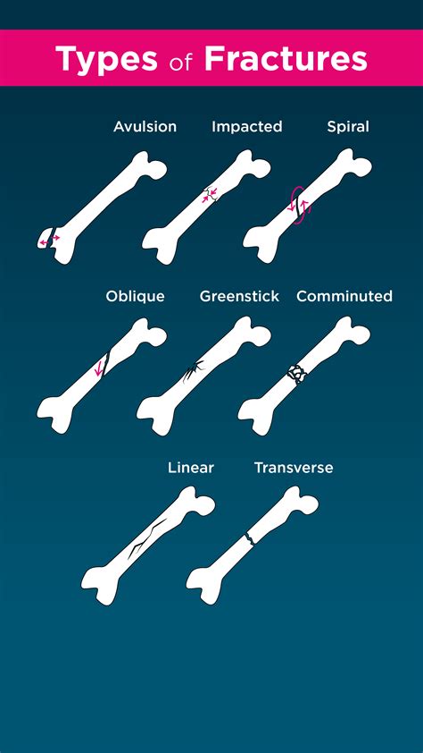 Types of bone fractures: How to tell if it's broken | Types of bones, Nurse study notes, Bone ...