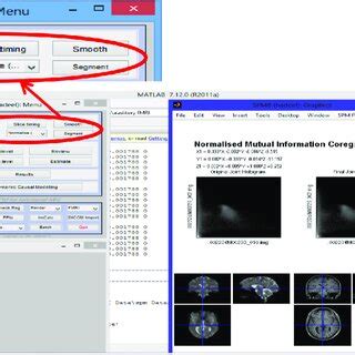 Statistical Parametric Mapping 的图像结果