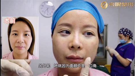 双眼皮手术术后分享🌟 - YouTube