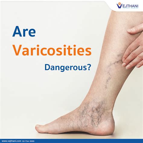 Are Varicosities Dangerous? - Vejthani Hospital