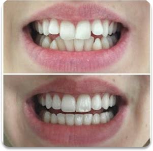 Braces for crooked teeth : The types, process & benefits