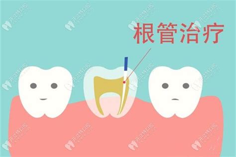 都是牙疼的感觉，那么该如何区分牙髓炎和根尖炎？ - 知乎