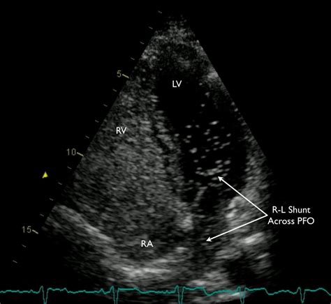 PFO Defect 的图像结果