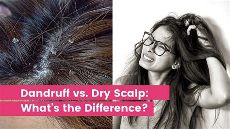 Dandruff Vs Dry Scalp