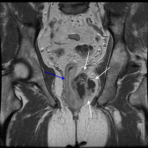 Perirectal / Perianal Abscess - Gastrointestinal - Medbullets Step 2/3