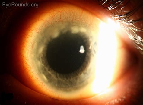 Corneal Marginal Ulcer