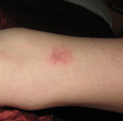 Ice Pack Burn Scar Treatment at Spencer Neighbour blog