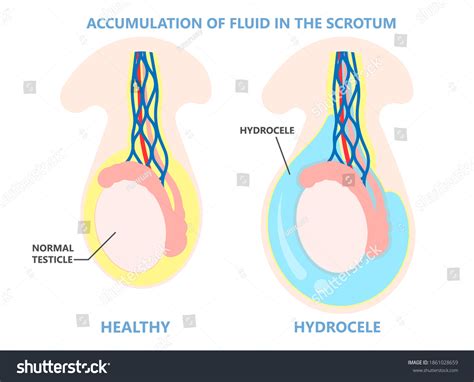 Spermatocele Vs Hydrocele