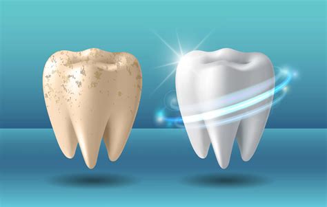 Dental Cavity vs Stains : Know The Difference | Vitapera