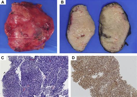 Nonmesothelial Spindle Cell Tumors of Pleura and Pericardium - Surgical ...