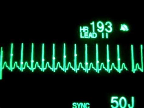 Image result for Synchronized Cardioversion SVT