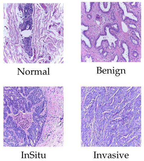 DCS-ST for Classification of Breast Cancer Histopathology Images with ...