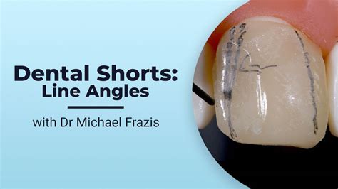 Line Angle Teeth 的图像结果