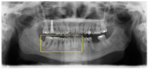 Adult Patient Risk Stratification Using a Risk Score for Periodontitis