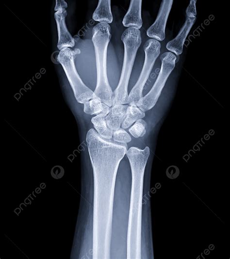 Right Hand X Ray Normal