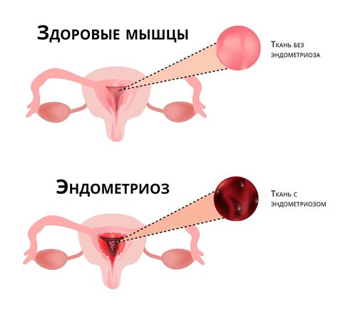 Понимаем суть эндометриоза и обсуждаем методы его лечения | Блог мед ...