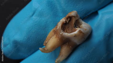Decayed Tooth Pulling 的图像结果