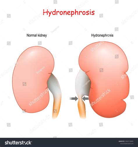 Hydronephrosis Normal Humans Kidney Kidney Affected: Vector có sẵn ...
