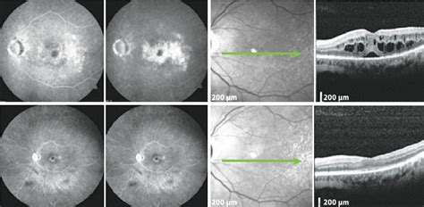 Mild Cystoid Macular Edema