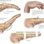 Image result for Finger Dislocation Reduction