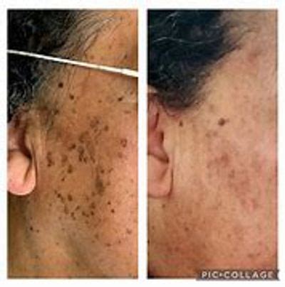 Pigmantation solutions | GLOWSYL AESTHETICS