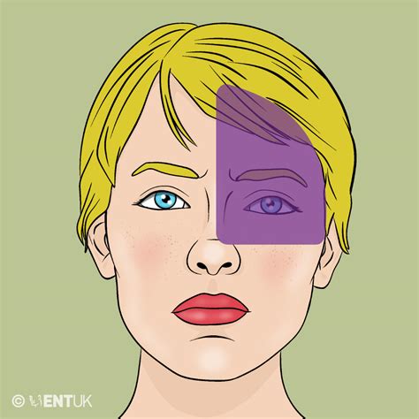Vestibular migraine | ENT UK