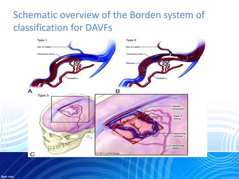 Dural arteriovenous fistula & AVM | PPTX