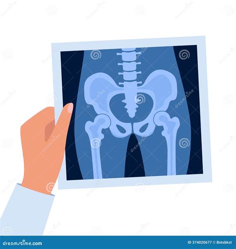 Hip Joint Pelvis Human Bones Anatomy Orthopedic Medical Diagnostic ...