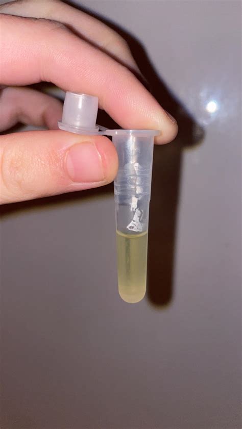 Spinal Fluid Leaking From Ears Cerebrospinal Fluid Leak Imaging: