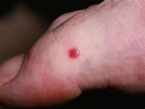 Kaposi sarcoma causes, symptoms, lesions, prognosis and treatment